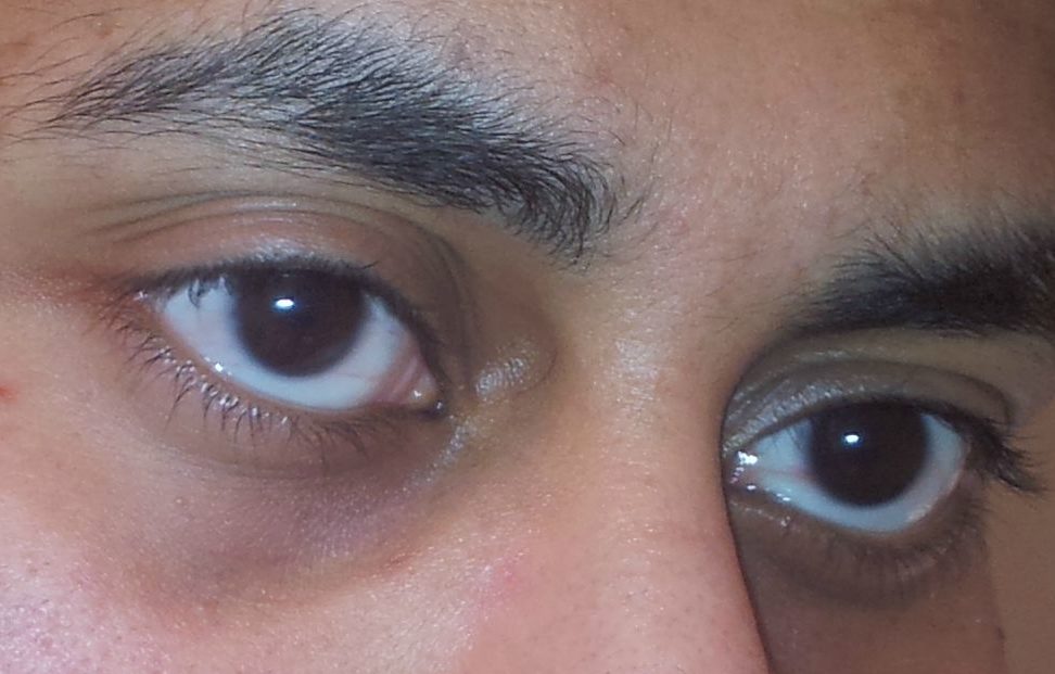 Причины появления синяков под глазами – почему появляются темные круги у женщин и мужчин, каким бывает лечение мешков у взрослых девушек и как избавиться от возникновения постоянных и сильных следов