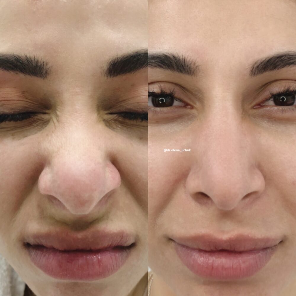 Коррекция носа
