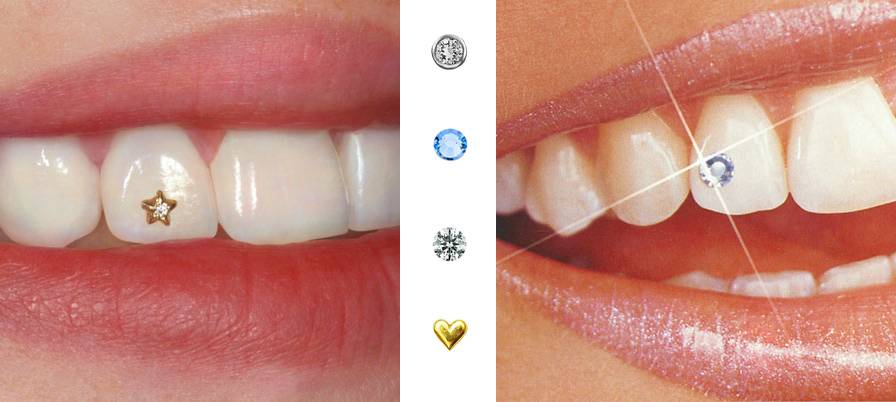 Скайс на зуб: фото декорирования, виды украшений в стоматологии и их установка