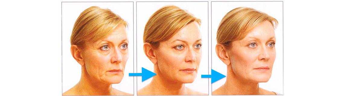Типы старения кожи и как они влияют на результаты фейслифтинга - beauty doctor