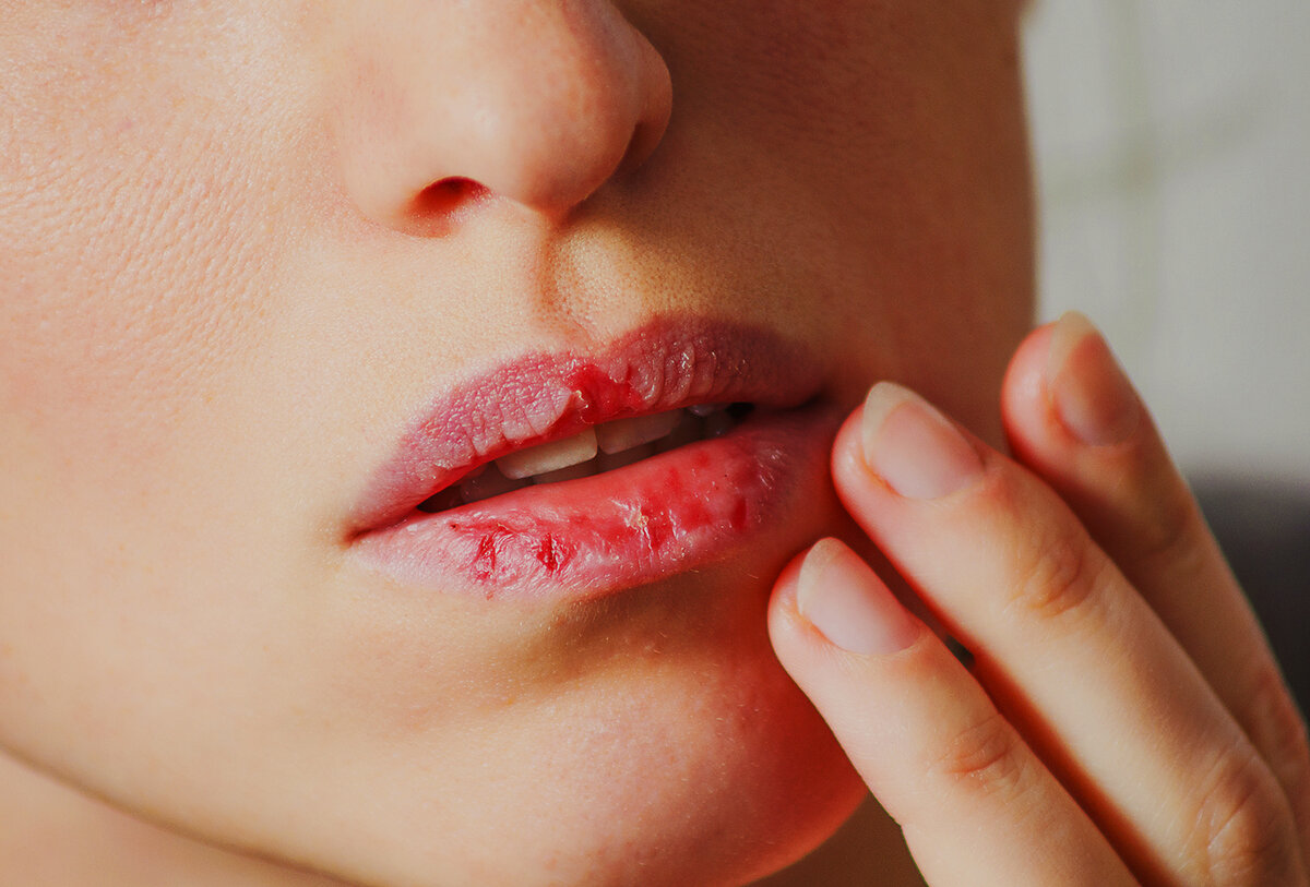 Что делать с сухими губами, причины и уход | colgate