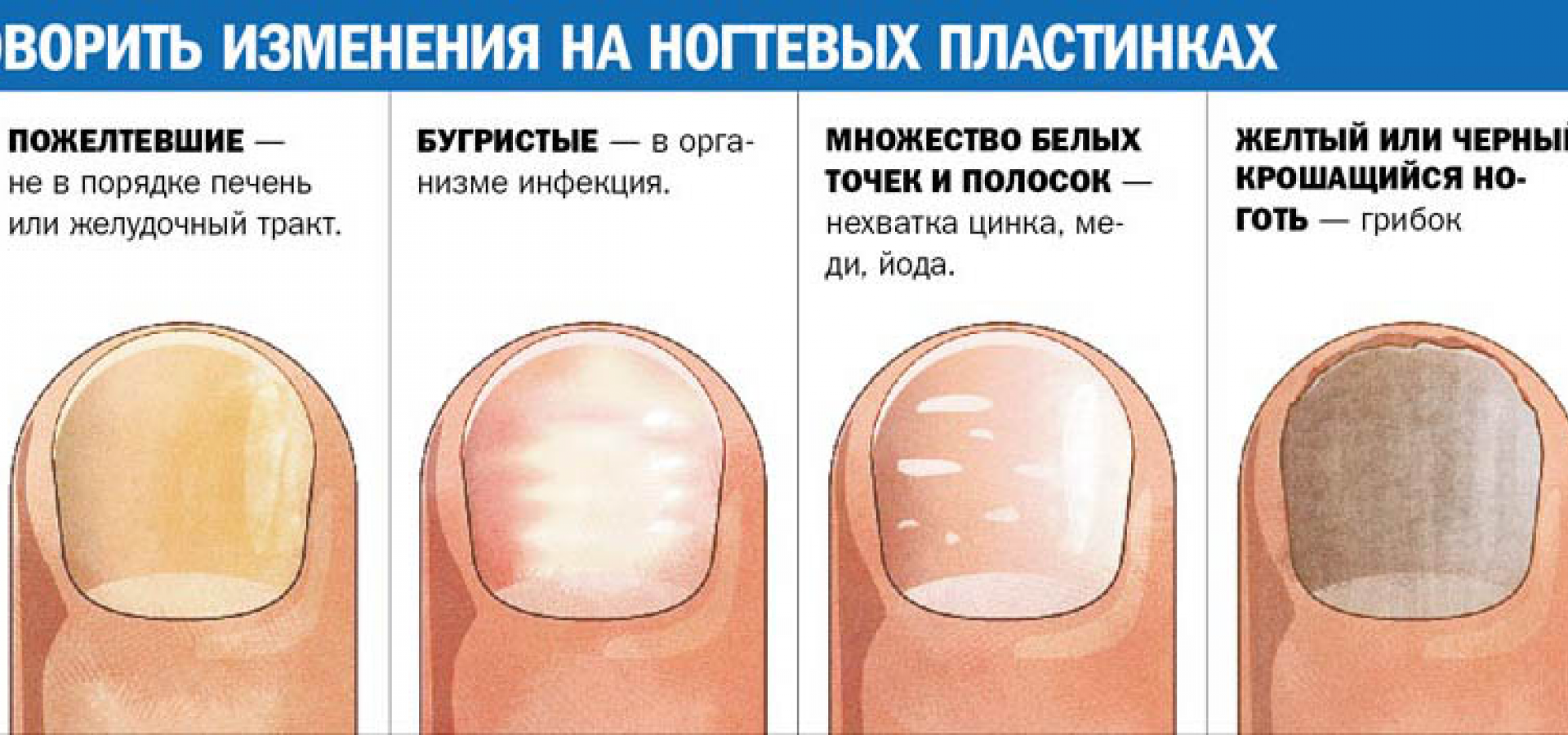 Деформация ногтевой пластины