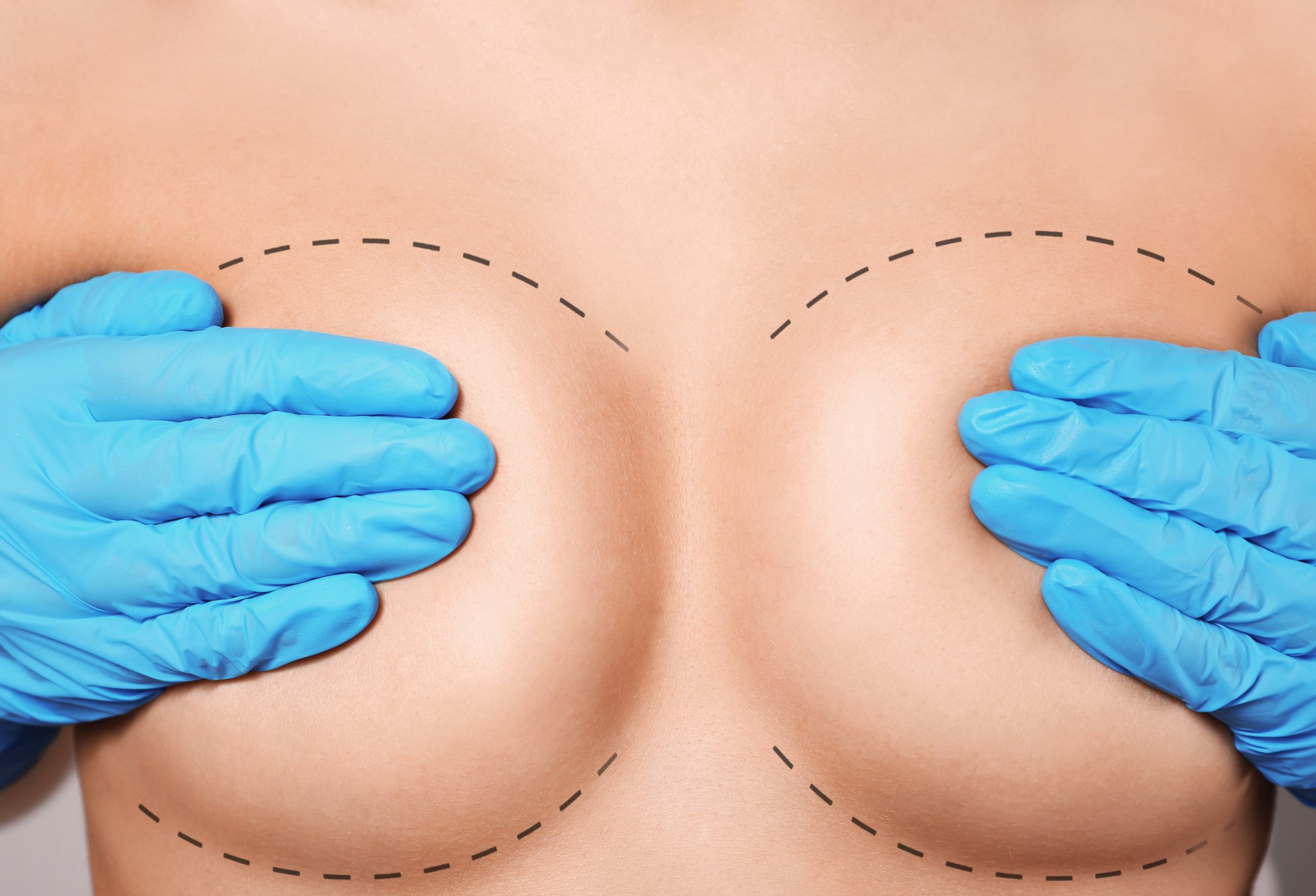операция грудь женщин фото 18