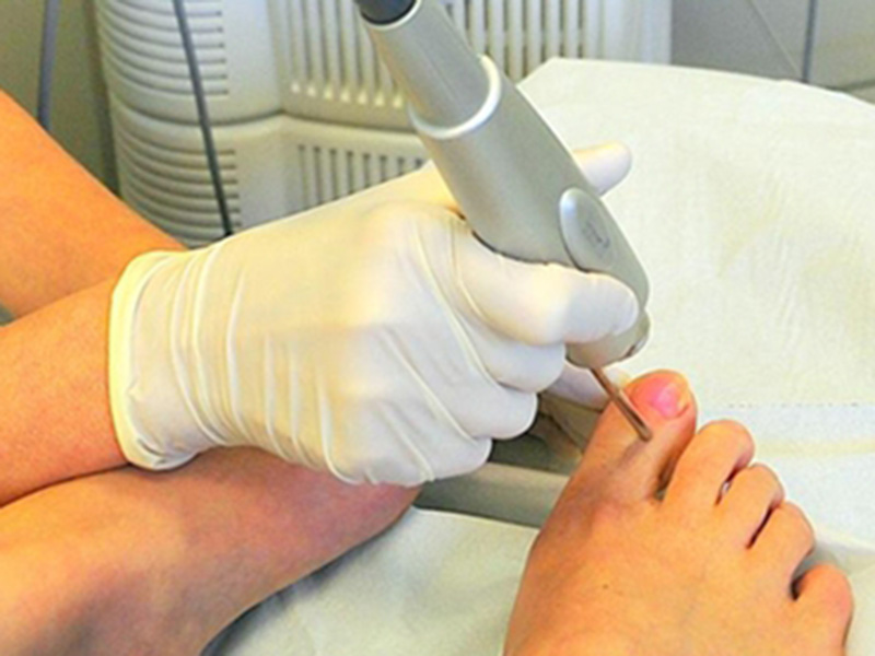 Лечение грибка ногтей лазером в краснодаре | центр эстетической медицины "солнце"