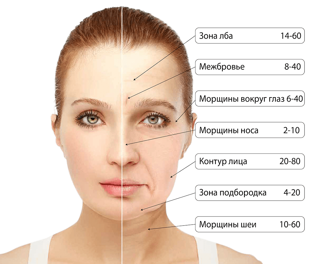 Ботокс солярий когда можно. Схемы ботулинотерапии рефайнекс. Зоны для ботокса на лице. Схема введения ботокса. Схема для диспорта.