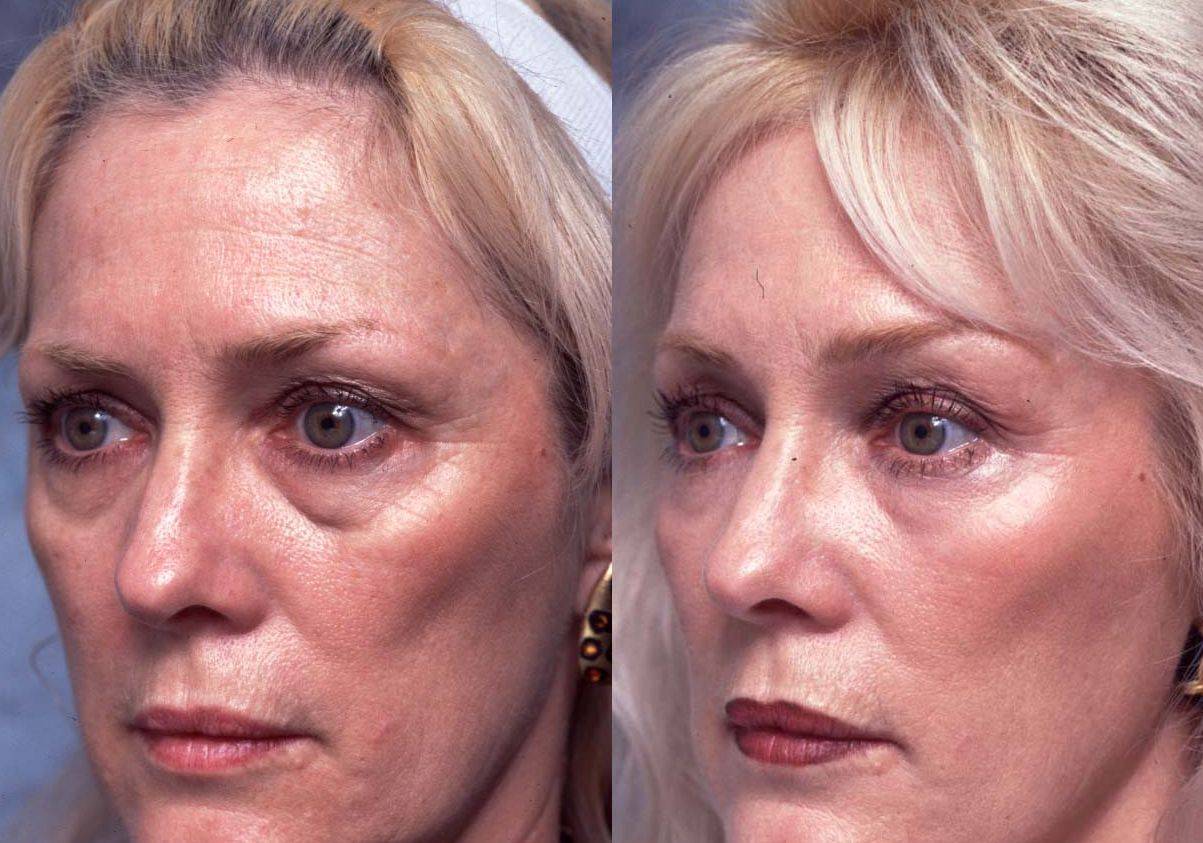 Процедуры для омоложения лица: самая эффективная, косметические, косметологические, лазерные