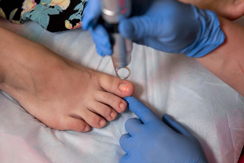 Можно ли вылечить лазером грибок ногтей — эффективность процедуры, техника и противопоказания