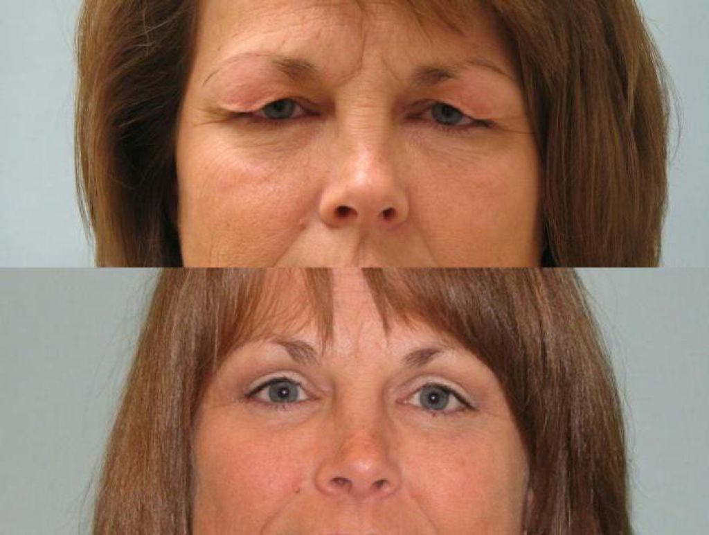 Блефаропластика до и после фото женщины 50 лет