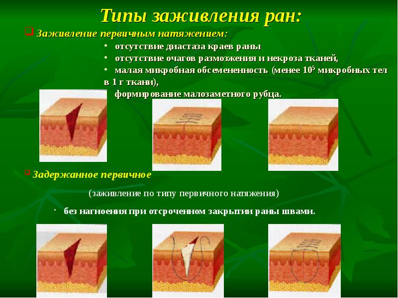 Чтобы болячка быстрее зажила. Заживление РАН первичным натяжением. Первичное и вторичное натяжение заживление РАН. Зажиалпние первычным гатчжением. Рана заживает первичным натяжением.