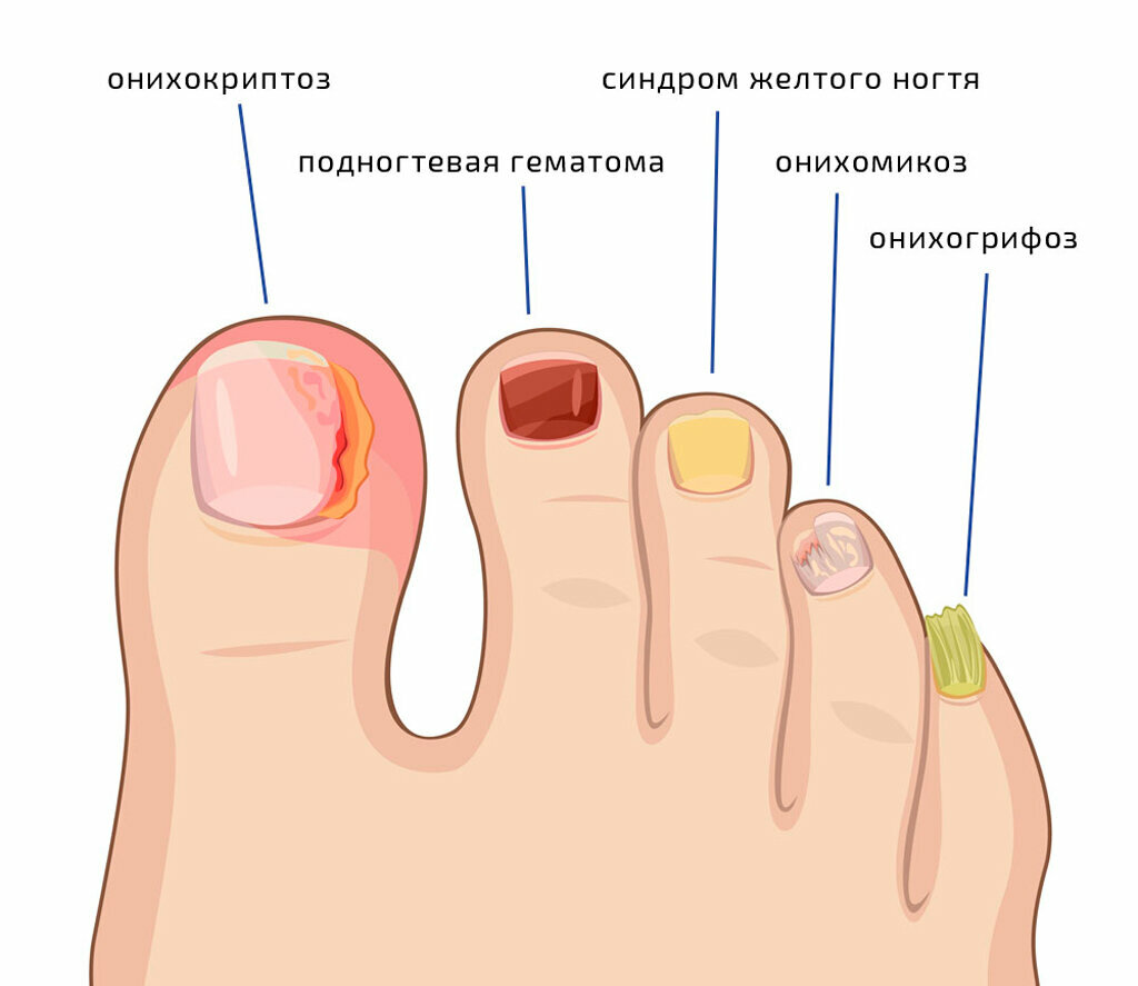 Гной на пальце ноги возле ногтя: причины, способы лечения