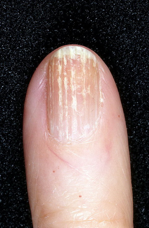 Лечение болезней и повреждений ногтей и кутикулы. о чём говорят деформации, ломкость и изменение цвета ногтей