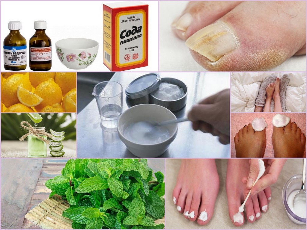 Грибок ногтей на ногах и руках: фото, симптомы и лечение онихомикоза – напоправку