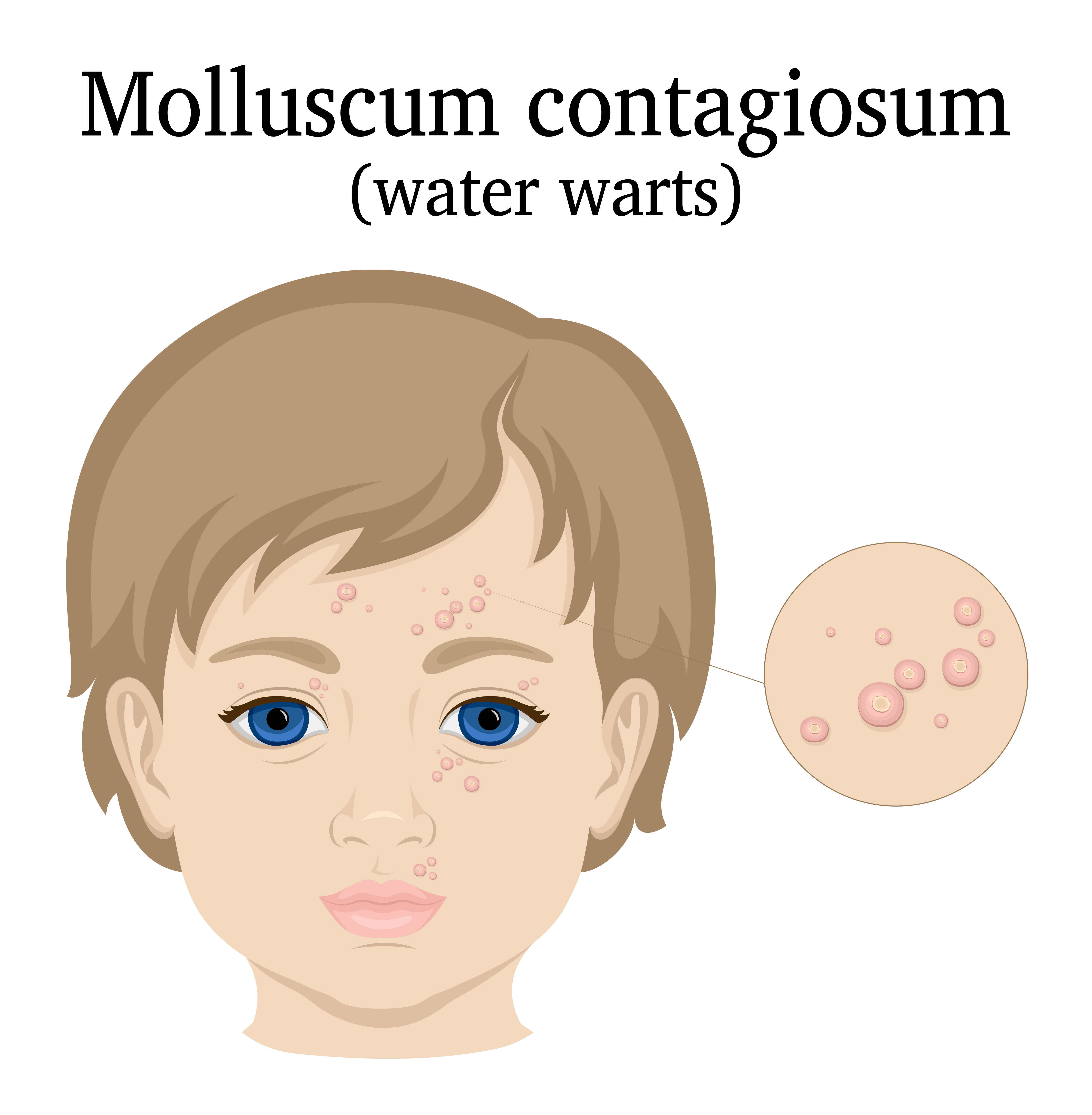 Контагиозный моллюск у детей: фото на коже, лечение и удаление на разных стадиях болезни