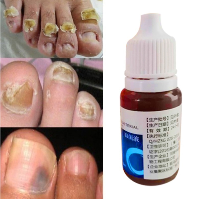 Грибок, болезни ногтей