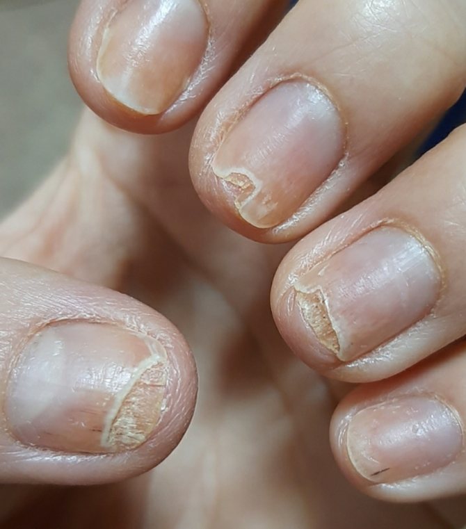 Восстанавливаем ногти после наращивания дома