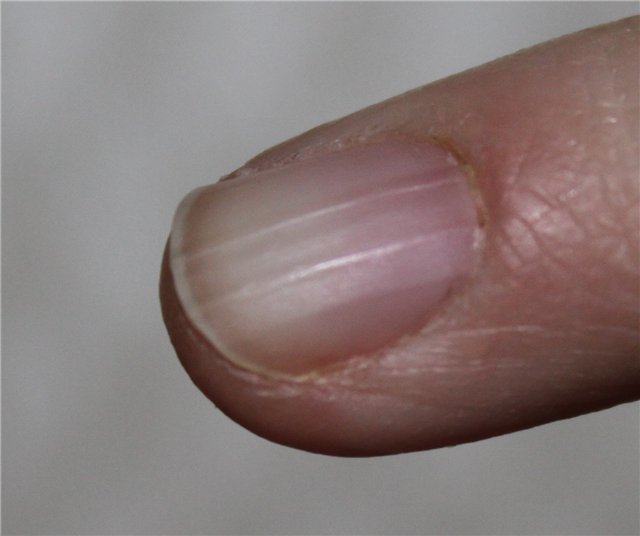 Почему трескаются ногти на руках вдоль или поперек, как отремонтировать и восстановить