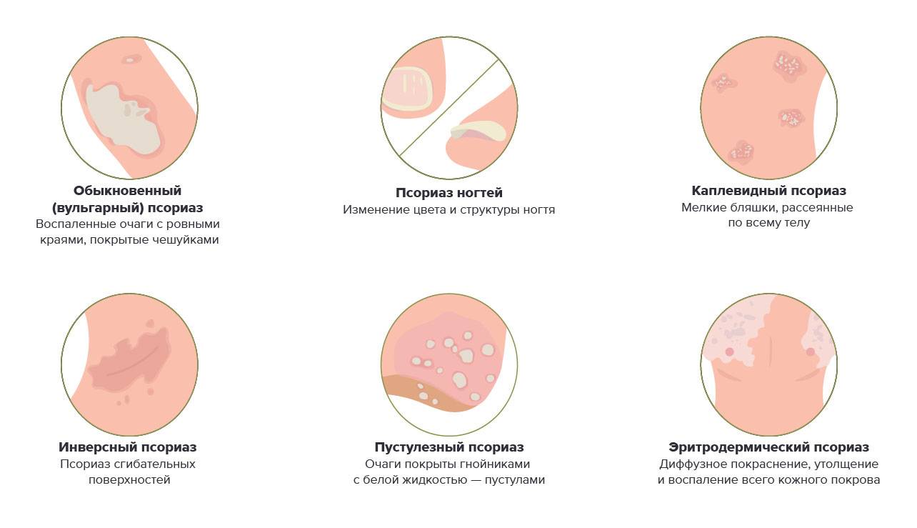 Разноцветный лишай схема лечения