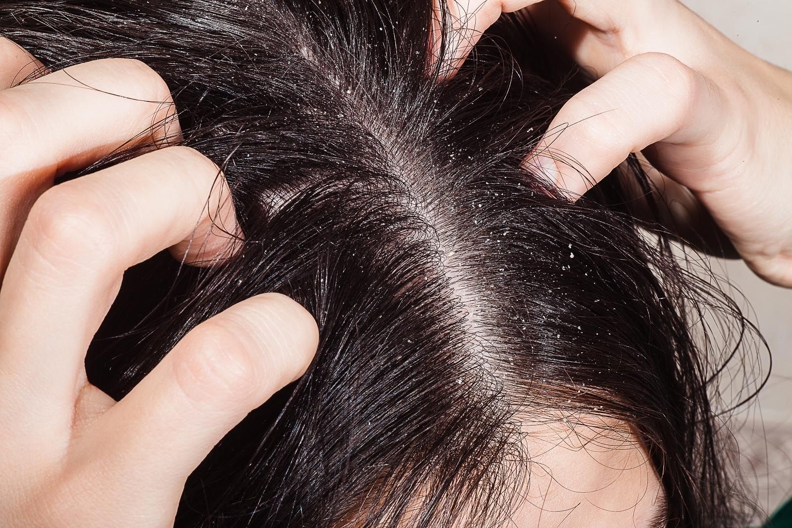 Сильное выпадение волос у женщин: причины, что делать?