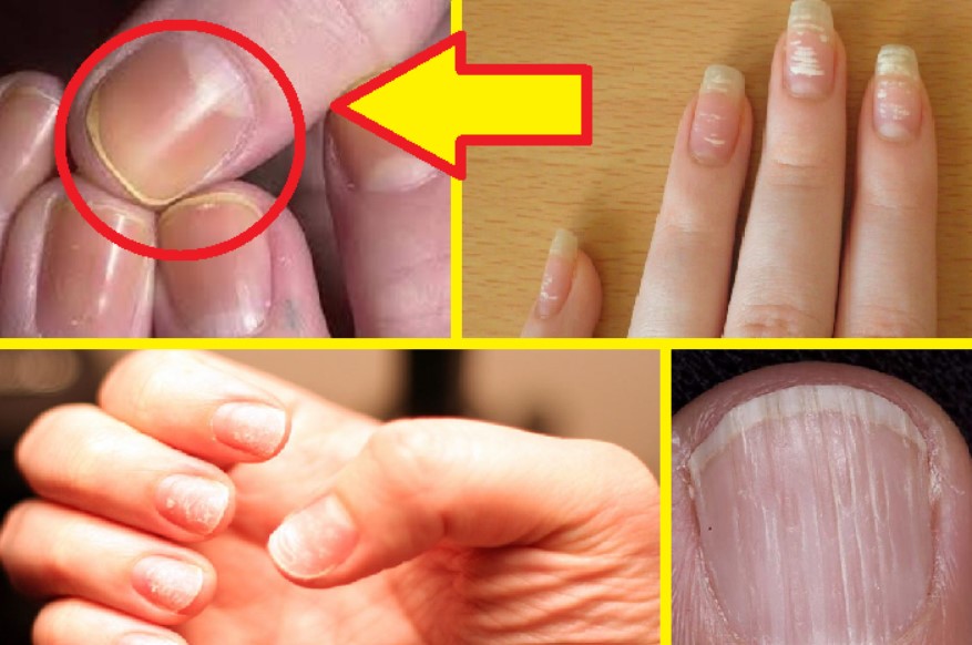 Изменение толщины ногтя | центр подологии и остеопатии татьяны красюк