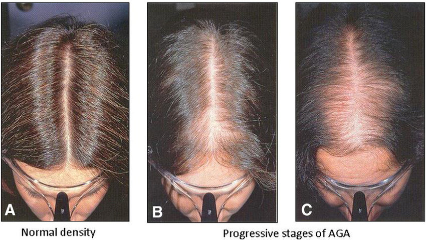 Можно ли восстановить волосы при андрогенном облысении у женщин