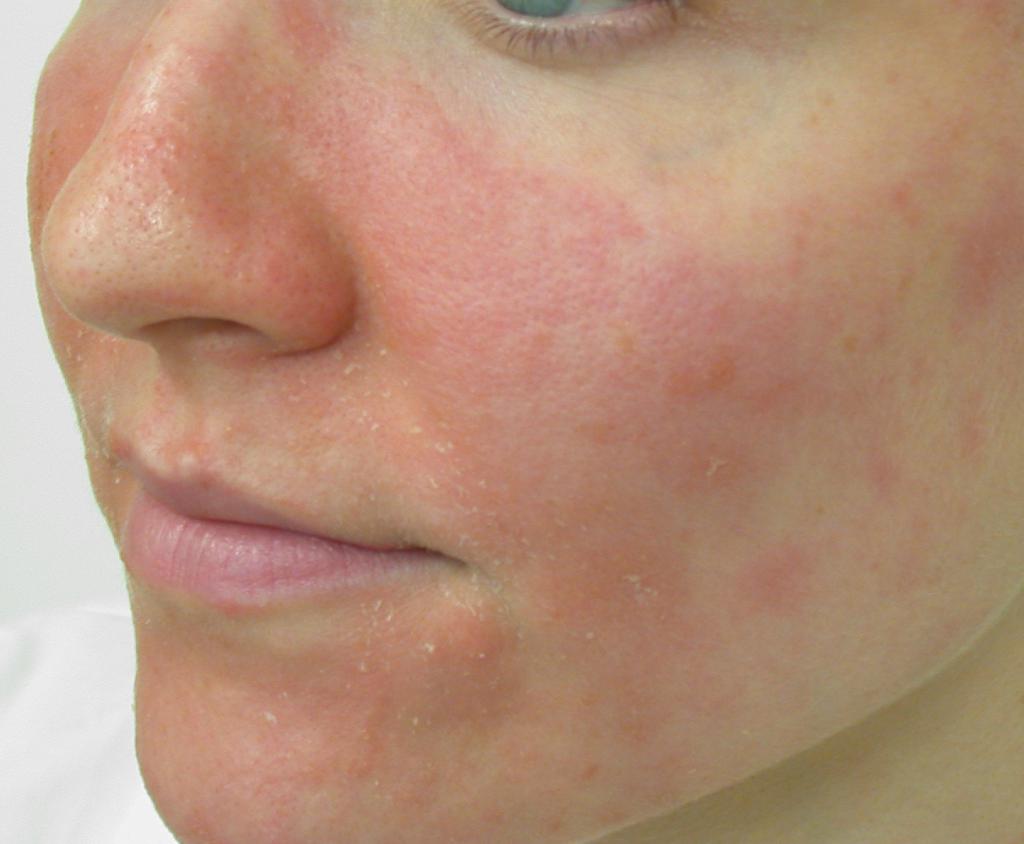 Себорейный дерматит на лице у взрослого: лечение, симптомы – эл клиника