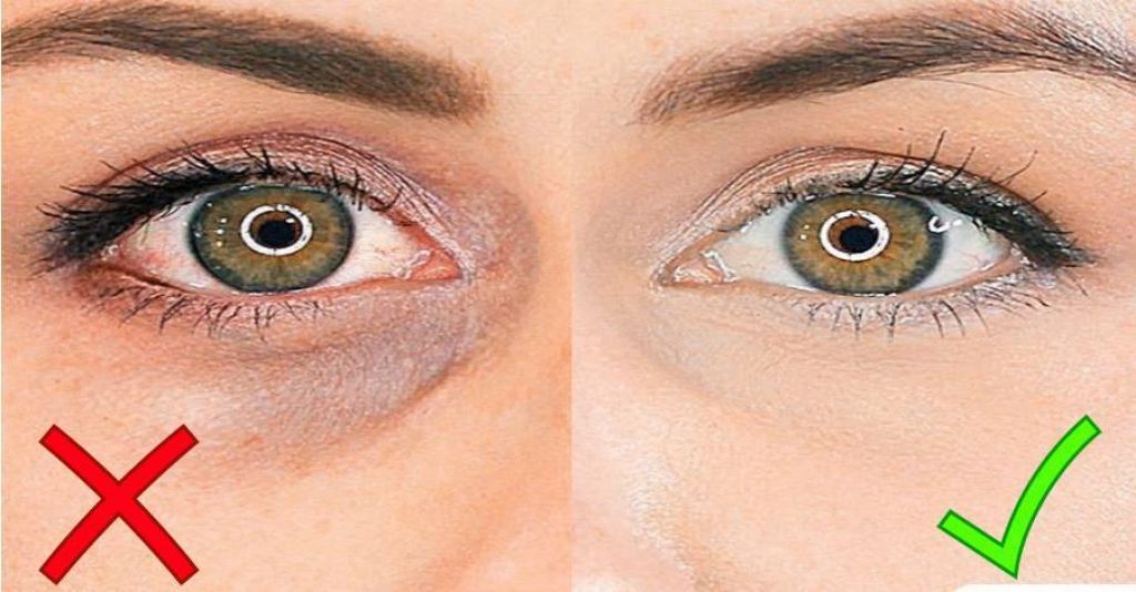 Как убрать синяки под глазами: косметология и процедуры в салонах красоты такие как филлеры, мезотерапия, блефаропластика, липолифтинг