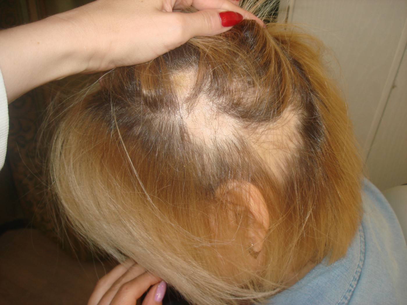 Почему у ребенка выпадают волосы на голове - детская городская поликлиника №1 г. магнитогорска