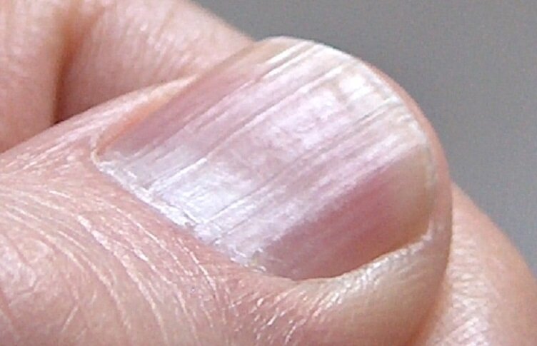 Темные пятна, линии на ногтях и под ногтями, причины, как лечить