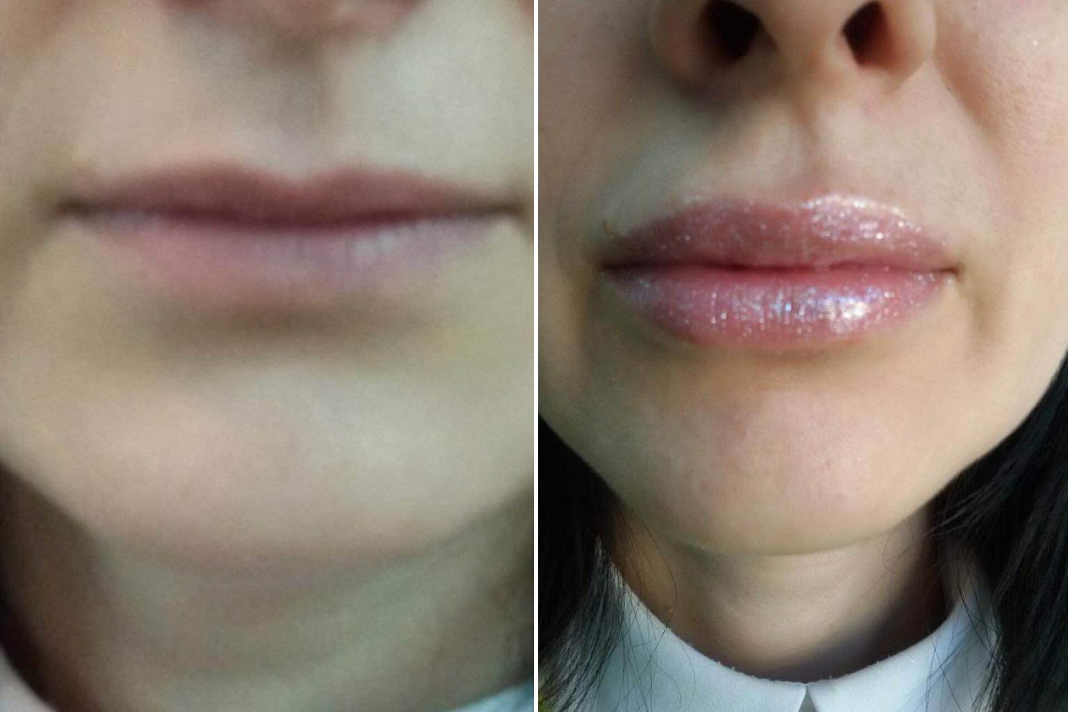 Реабилитация после увеличения губ: что нельзя и что можно? - блог клиники медиэстетик