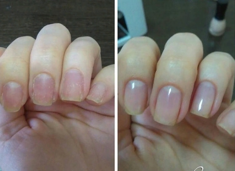 9 советов, которые помогут восстановить ногти после гель-лака
