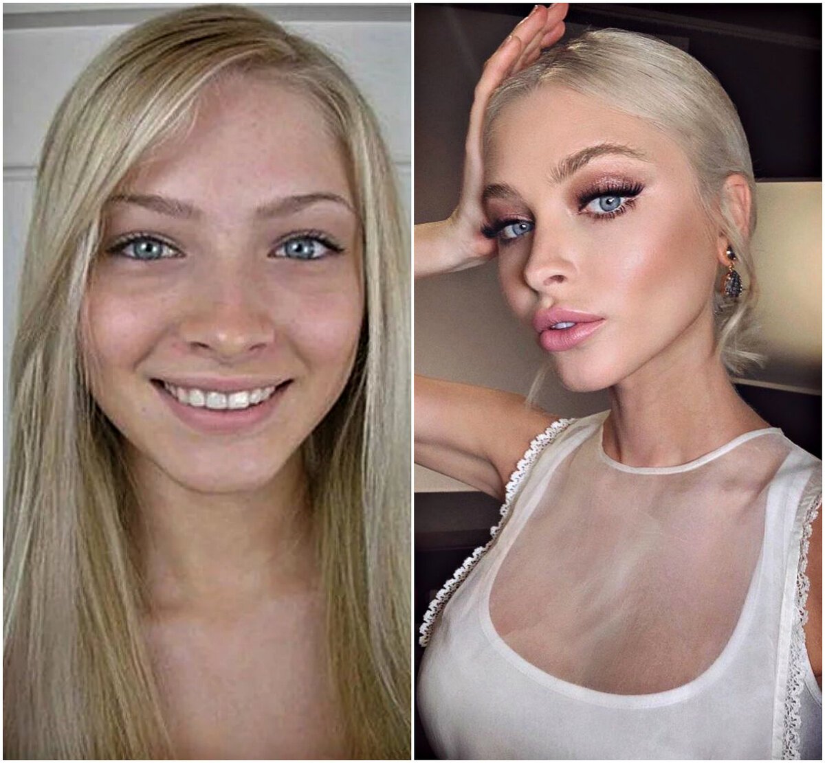 Алена шишкова до и после пластических операций, фото и видео