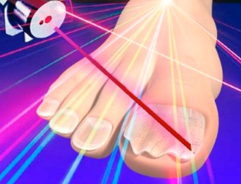 Лазерное удаление грибка ногтей - какие виды лазера используются, техника лечения