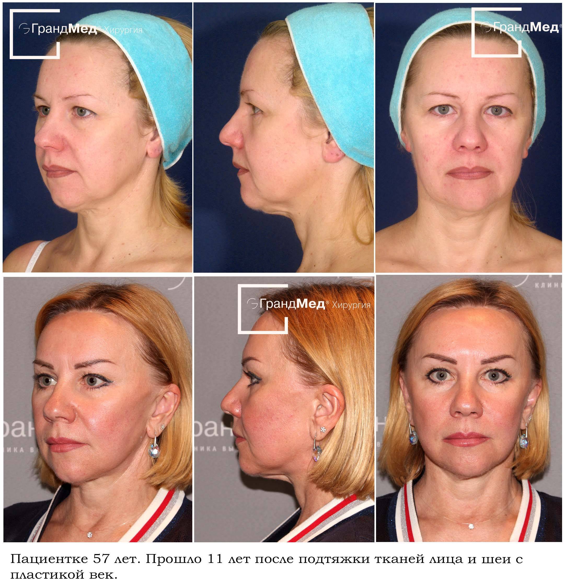 Хирургическая подтяжка лица (фейслифтинг), сколько стоит сделать контурную подтяжку лица и шеи в клинике спб