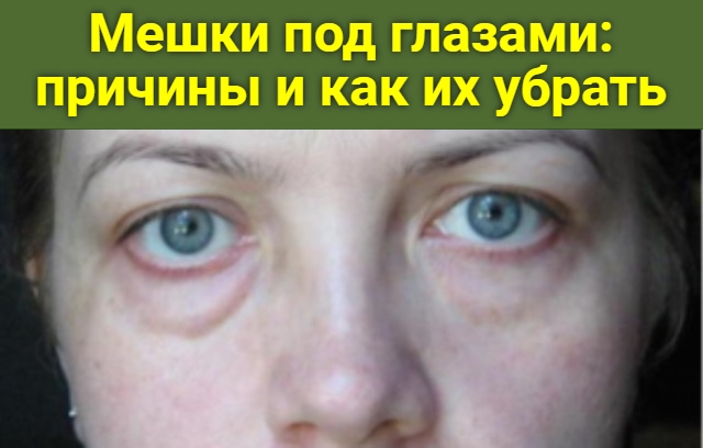 Что делать при отеках: виды и причины отеков, как избавиться от отеков