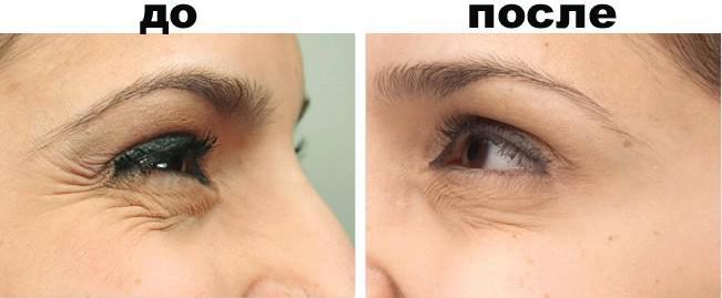 Гусиные лапки вокруг глаз: как избавиться с помощью салонных средств, масок, компрессов и массажа