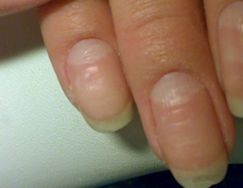 Трещина на ногтях рук: лечение и причины (почему трескаются ногти)