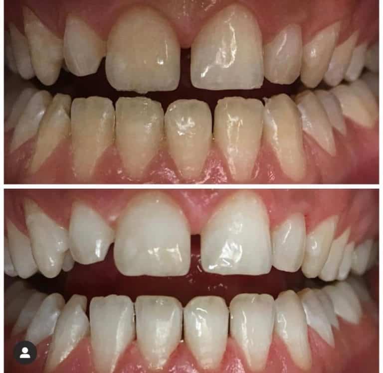 Домашнее отбеливание зубов - плюсы и минусы