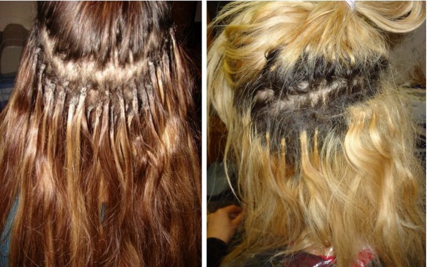 Лечение выпадения волос после наращивания - клиника ренео.