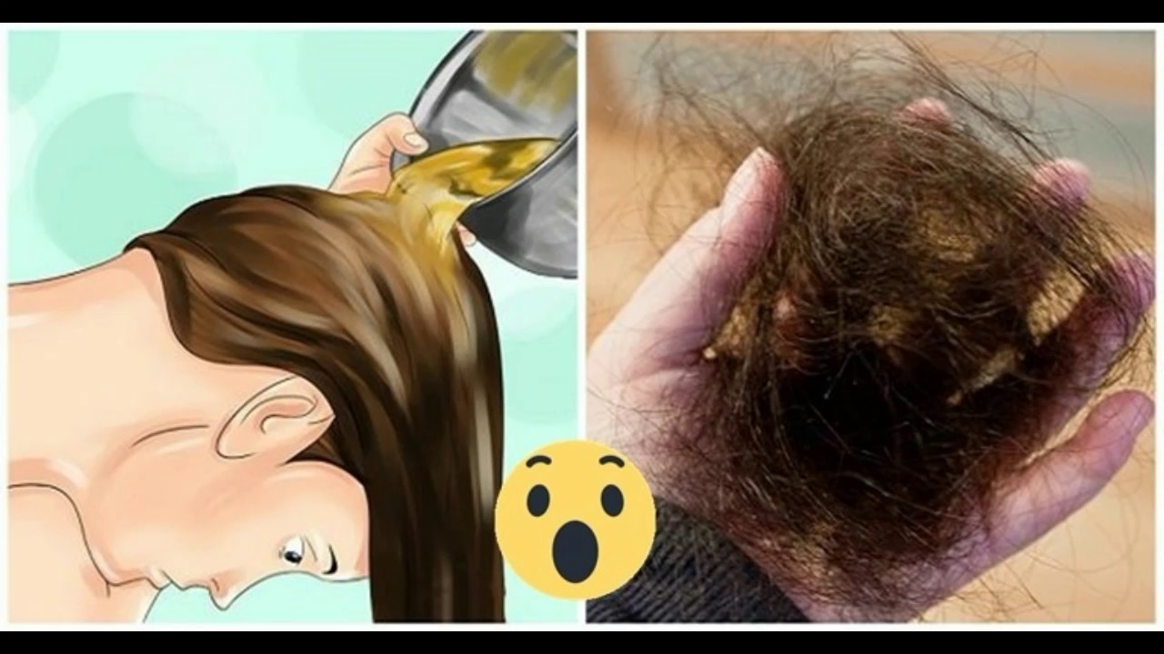 Сильное выпадение волос у женщин
