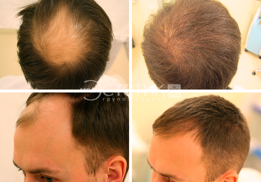 Как восстановить рост волос на полысевших участках головы у мужчины