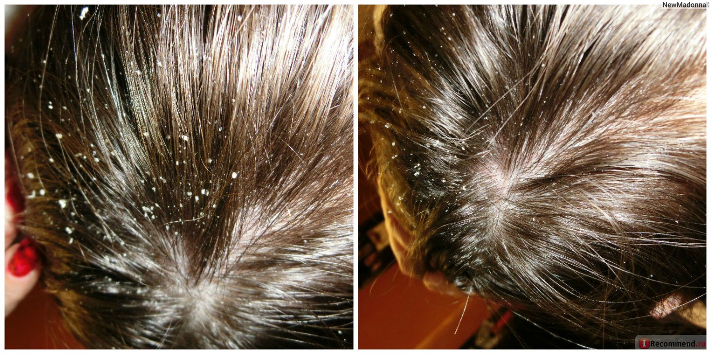 Прыщи на голове у женщин в волосах: гормональные причины, чем лечить | романов георгий никитич