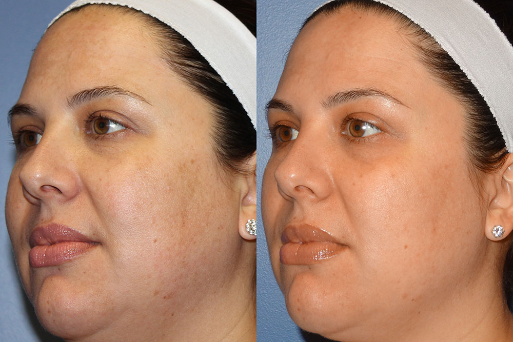 Алмазный пилинг лица - результаты и отзывы. фото до и после