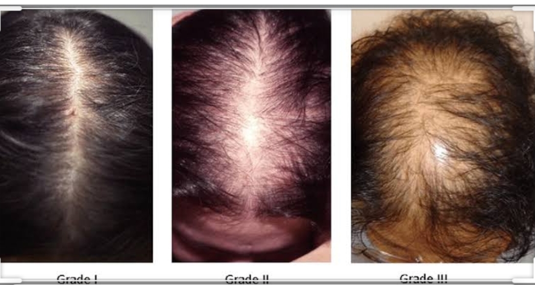 Диффузное выпадение волос у женщин - причины, симптомы, лечение