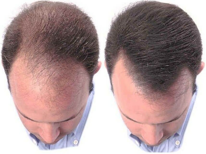 Восстановление волос у мужчин