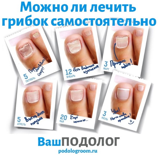 Топ-10 лучшее средство от грибка ногтей: как выбрать, как пользоваться, характеристики, отзывы