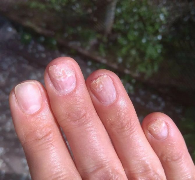 Ногти после наращивания — почему требуется восстановление? укрепление и восстановление ногтей в домашних условиях? обзор действенных процедур по восстановлению ногтей