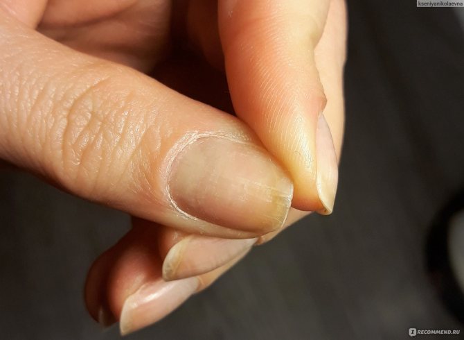 Почему отслаивается гель-лак у основания, со стороны и от свободного края ногтя