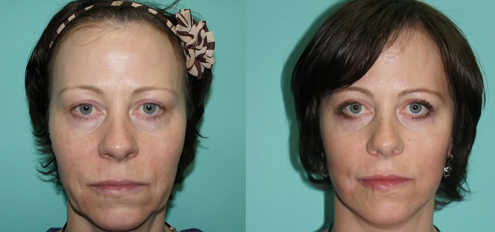Клинический случай: full-face коррекция лица с restylane lyft  | портал 1nep.ru