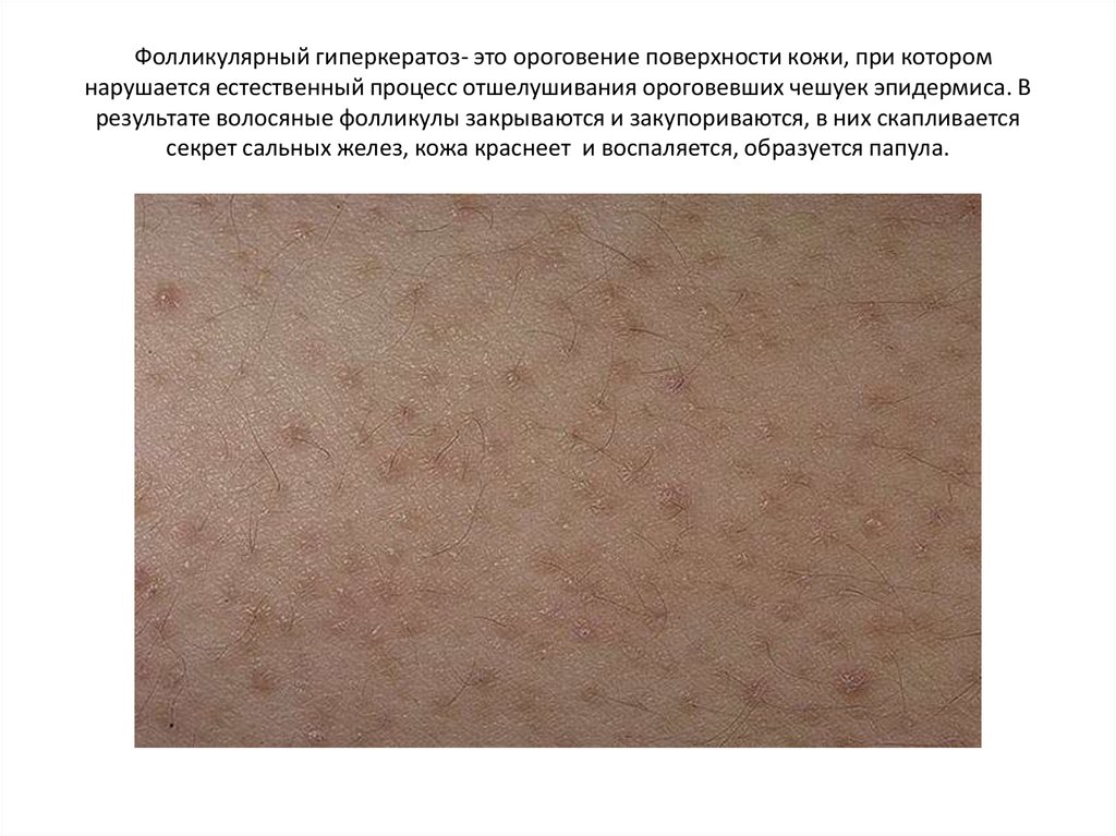 Гиперкератоз кожи лица: что это такое, симптомы, виды, лечение