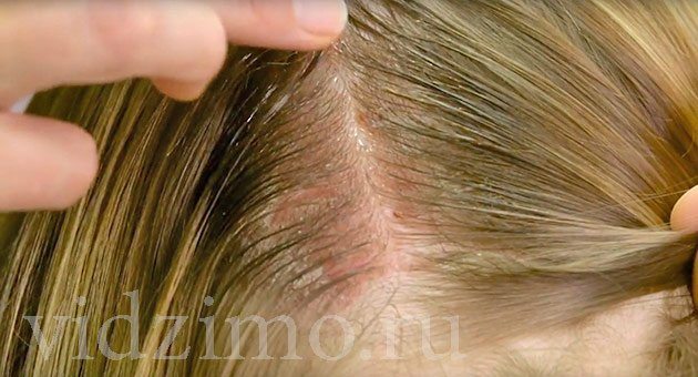 Выпадение волос у женщин: причины и лечение